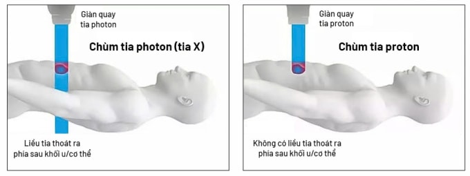 Xạ trị photon (tia X) đưa liều xạ vào khối u nhưng vẫn có thể đi xuyên qua phía sau, có thể gây tổn thương mô lành quanh đường đi của tia; trong khi đó xạ trị proton hiện đại với tia năng lượng biết dừng đúng chỗ ngay vị trí khối u để tiêu diệt khối u.Ảnh: Bệnh viện Tâm Anh