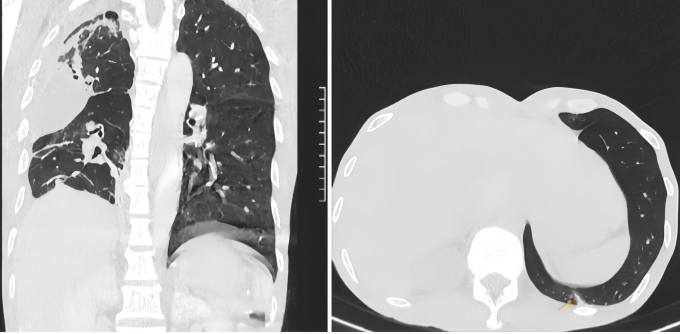 Ảnh chụp CT của người bệnh cho thấy phổi đã đông đặc do mủ. Ảnh: Bệnh viện Đa khoa Tâm Anh
