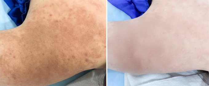 Vùng tăng sắc tố của Ánh cải thiện sau ba lần bắn laser pico pro. Ảnh: Bệnh viện Đa khoa Tâm Anh