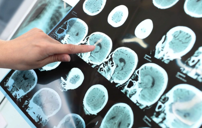 Đột quỵ não là một bệnh lý xảy ra đột ngột, diễn tiến nhanh, biến chứng nặng nề. Ảnh: Health
