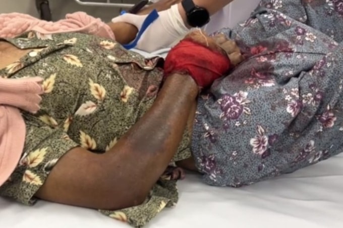 Tay nạn nhân có dấu hiệu hoại tử khi chuyển viện cấp cứu. Ảnh: Nguyễn Hà