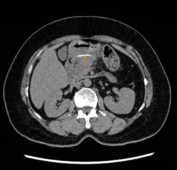 Ảnh CT cho thấy xương cá nằm ở hậu cung mạc nối, sát môn vị (mũi tên vàng). Ảnh: Bệnh viện Đa khoa Tâm Anh