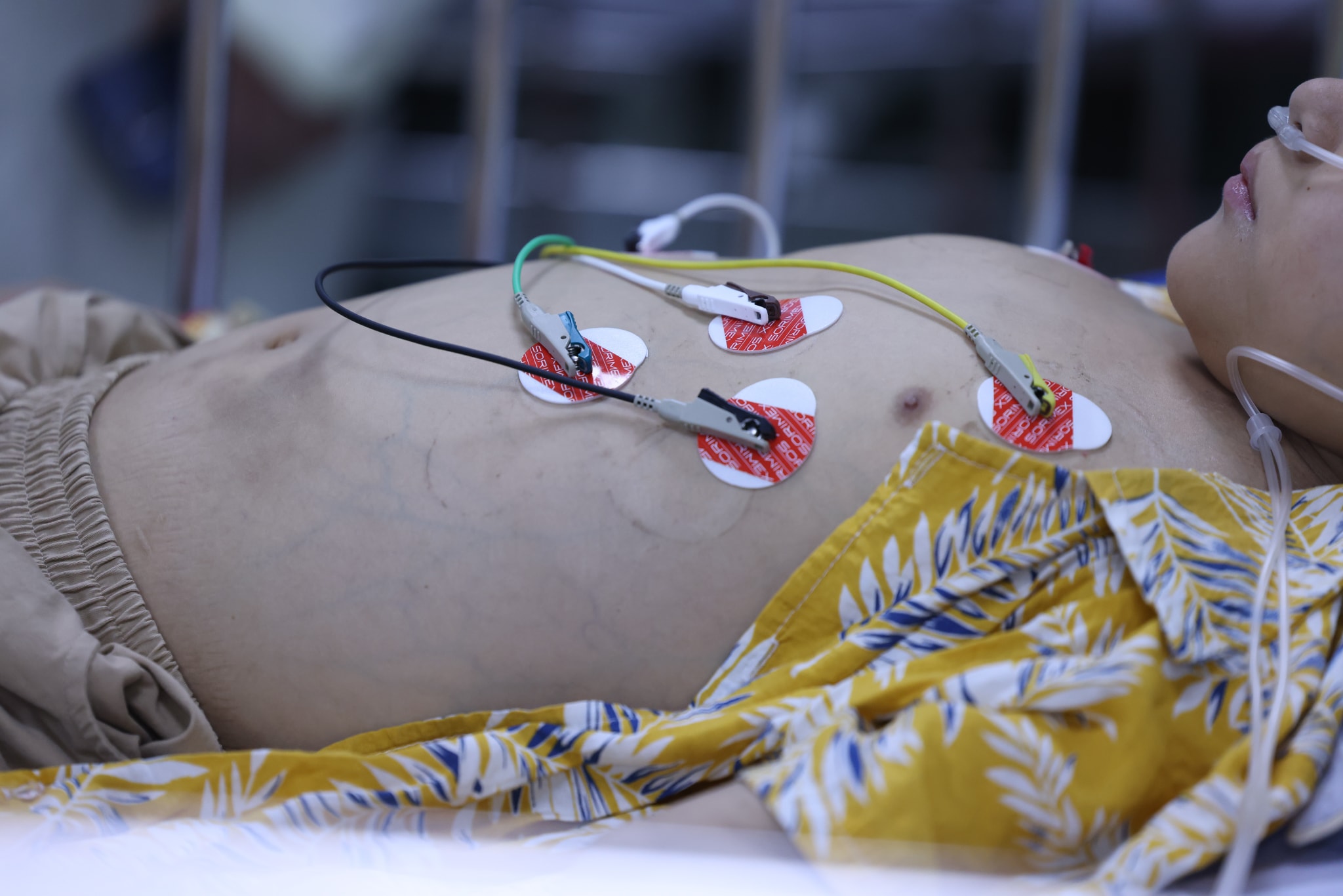 Sốt xuất huyết Dengue có thể chuyển nặng chỉ trong vài giờ.