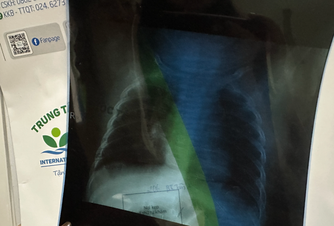 Xquang phổi của bé con chị Linh xác định viêm phổi nhẹ, kèm viêm tai giữa, ứ dịch, ho nhiều, buộc phải nhập viện. Ảnh: Nhân vật cung cấp