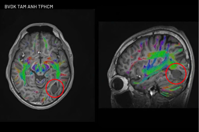 Hình ảnh DTI cho thấy khối u của Hoàng nằm sát các cấu trúc thần kinh quan trọng. Ảnh: Bệnh viện Đa khoa Tâm Anh