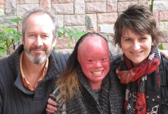 Rog và Tina Thomas bên con gái nuôi Mui, người mắc bệnh vảy cá Harlequin, ở Trung Quốc. Ảnh: SCMP