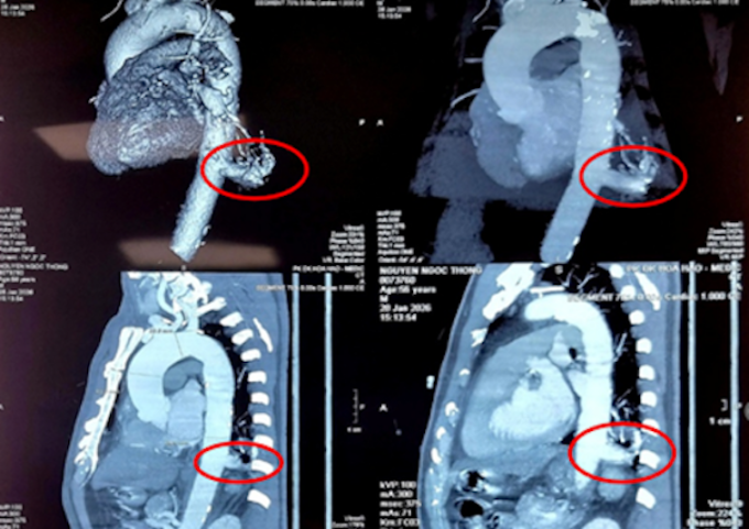 Hình ảnh phần phổi dư thừa của bệnh nhân trên phim chụp. Ảnh: Bệnh viện cung cấp