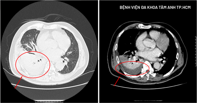 Ảnh CT phổi của ông Tỉnh ghi nhận tình trạng tràn dịch màng phổi (bên phải) và xẹp nhu mô phổi. Ảnh: Bệnh viện Đa khoa Tâm Anh