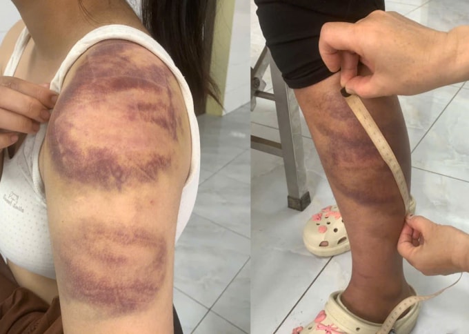 Con gái bị Minh đánh đập bầm tím khắp người. Ảnh: Công an cung cấp