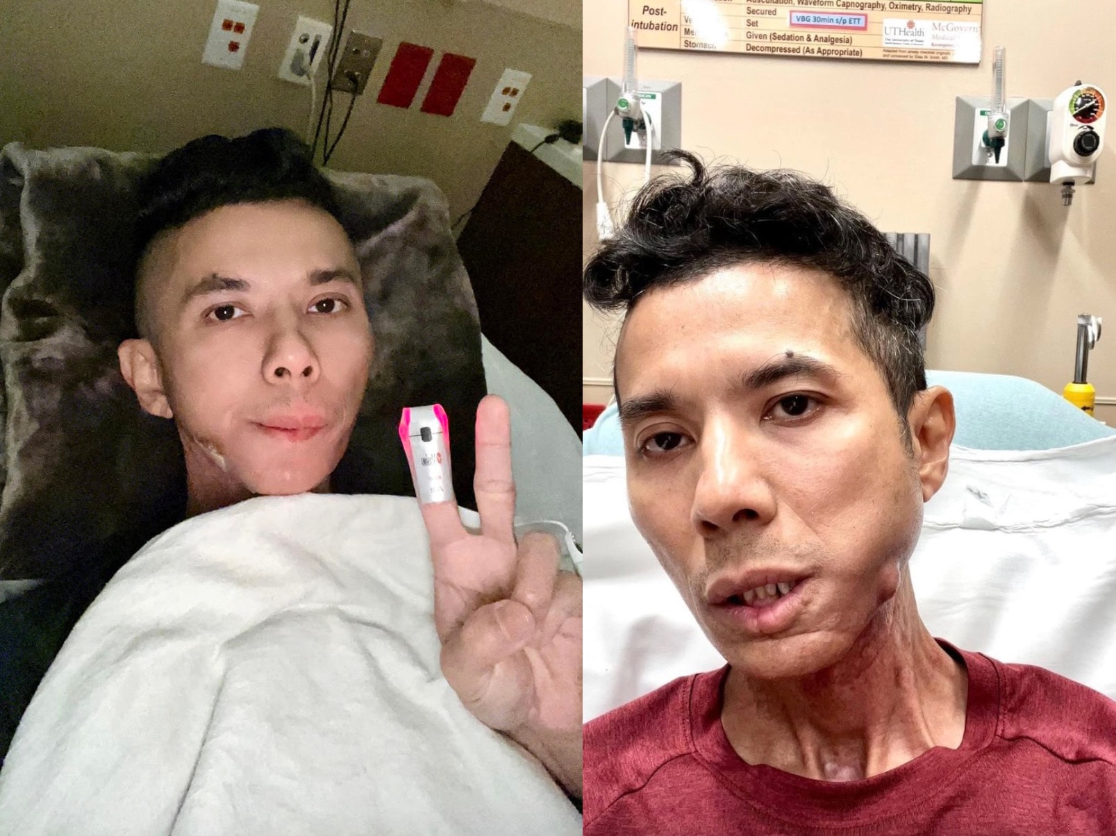 Năm 2024, Kasim Hoàng Vũ phải phẫu thuật xương hàm vì bệnh tình trở nặng.