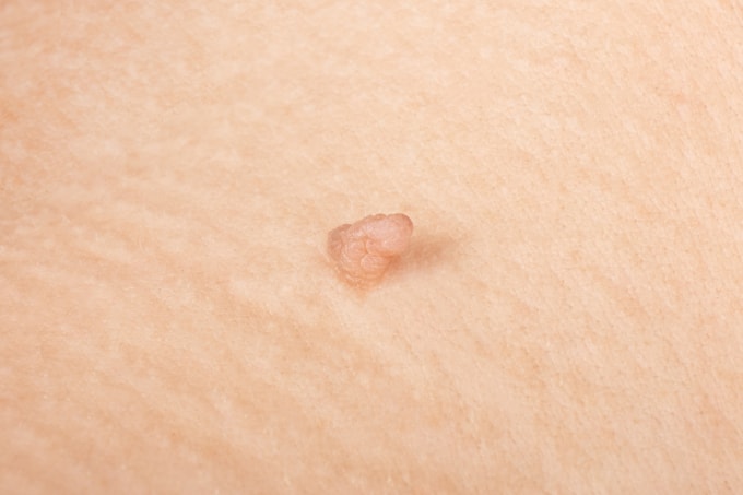 Sùi mào gà dễ nhầm lẫn với triệu chứng của bệnh khác. Ảnh minh họa: Vecteezy