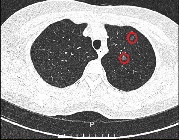 Hai nốt nhỏ ở thùy trên phối trái của bà Phương trên phim chụp CT liều thấp. Ảnh: Bệnh viện Đa khoa Tâm Anh