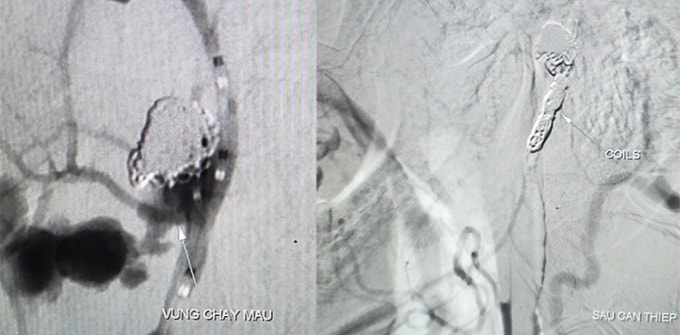 Hình ảnh ổ giả phình động mạch cảnh trong phải đoạn cổ bệnh nhân trước và sau can thiệp. Ảnh: Thanh Phong