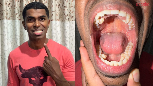 Người đàn ông nhiều răng nhất thế giới, bác sĩ lý giải nguyên nhân chuyện "xưa nay hiếm" - Ảnh 1.