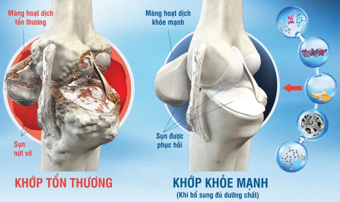 Mô phỏng khớp tổn thương và khớp khỏe mạnh. Ảnh: Công ty Cổ phần Dược phẩm Eco
