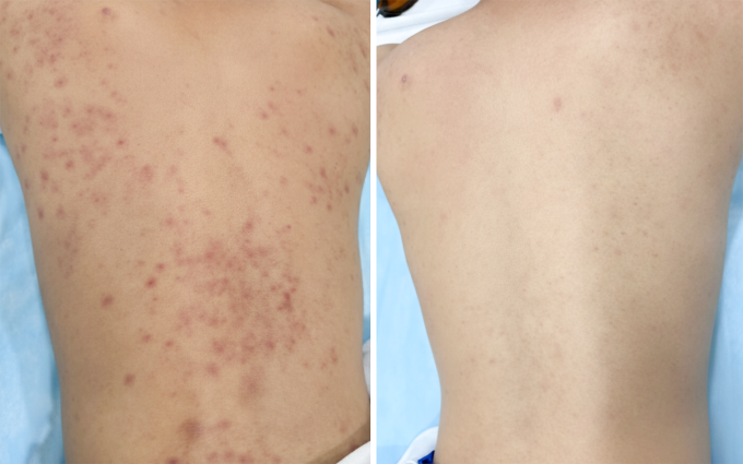 Phần lưng của anh Văn đã giảm mụn viêm và thâm sau 3 tháng điều trị. Ảnh: Bệnh viện Đa khoa Tâm Anh