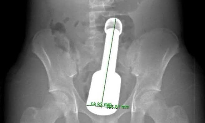 Hình ảnh chụp chiếu phát hiện dị vật trong trực tràng. Ảnh: Bệnh viện cung cấp