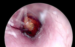 Nam thanh niên 15 tuổi đau bụng dữ dội, bác sĩ sốc khi phát hiện thứ "đáng sợ" bên trong - Ảnh 4.