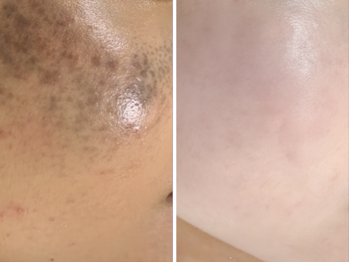 Vết bớt của Mai nhạt màu đáng kể sau 5 lần điều trị bằng laser. Ảnh: Bệnh viện Đa khoa Tâm Anh