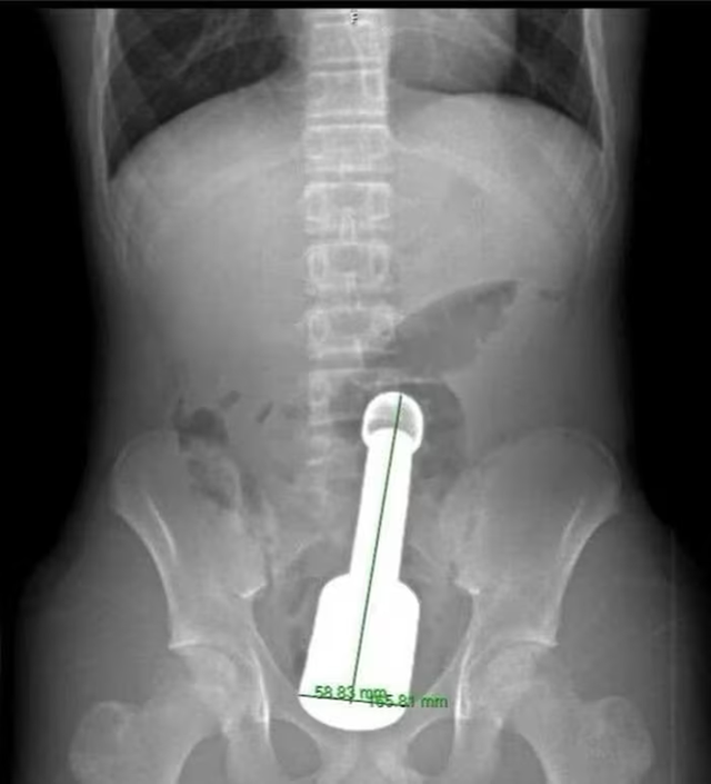 Nam thanh niên 15 tuổi đau bụng dữ dội, bác sĩ gắp ra thứ "đáng sợ" bên trong  - Ảnh 1.