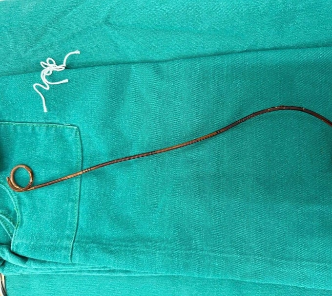 Chiếc sonde JJ để quên trong bụng bệnh nhân 2 năm. Ảnh: Bệnh viện cung cấp