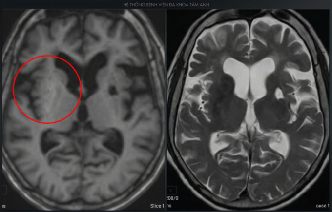 Ảnh MRI cho thấy vùng hạch nền - cấu trúc sâu trong não của bà Hoa đang bị tổn thương. Ảnh: Bệnh viện Đa khoa Tâm Anh