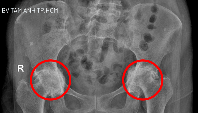 Kết quả chụp X-quang cho thấy khớp háng hai bên phá vỡ khung chậu và đang dần chui vào ổ bụng. Ảnh: Bệnh viện Đa khoa Tâm Anh