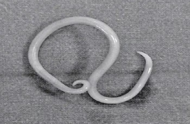 Thiếu niên 15 tuổi bị loét ruột nặng, bác sĩ phát hiện "bí mật" bên trong chứa đầy giun đũa - Ảnh 1.