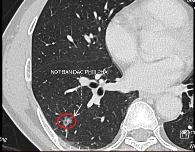 Nốt bán đặc ở thùy dưới phổi phải của ông Hoàng trên phim chụp cắt lớp vi tính. Ảnh: Bệnh viện Đa khoa Tâm Anh