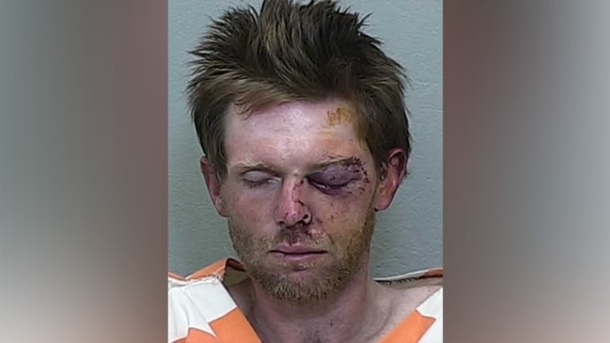 Bryce Thayer bị bầm tím, trầy xước mặt sau vụ việc. Ảnh: Marion County Sheriffs Office