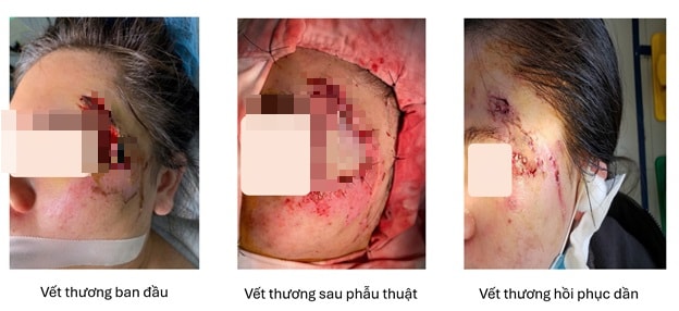 Cô gái bị hoại tử vùng mặt do tai nạn giao thông được ghép da thành công- Ảnh 1.