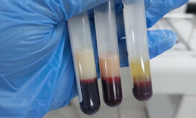 Kết quả xét nghiệm máu của bệnh nhân viêm tụy cấp. Ảnh minh họa: Hoàng Sơn