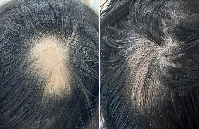 Nhiều tóc con của Thu đã mọc lại sau một lần tiêm hoạt chất (bên phải). Ảnh: Bệnh viện Đa khoa Tâm Anh