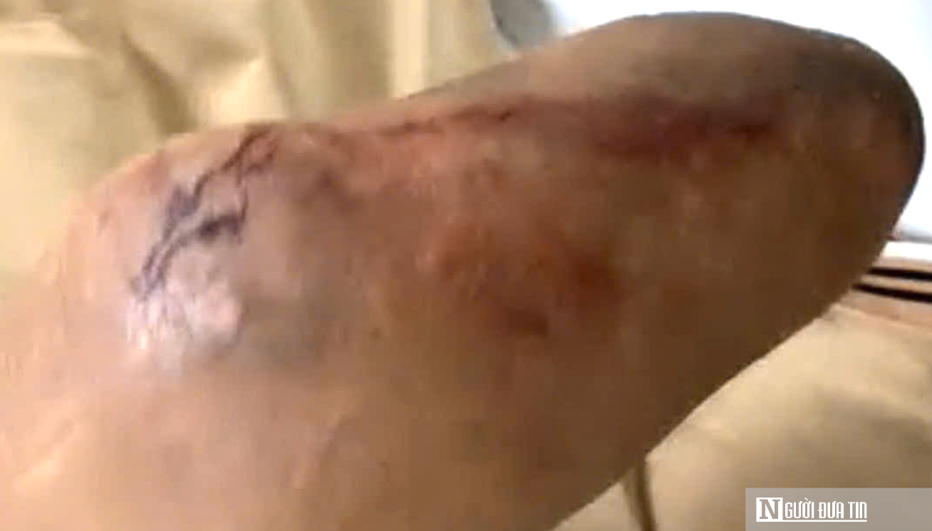 Nhiều bất ngờ về cụ ông bị hổ mang cắn vẫn giữ chặt con rắn- Ảnh 2.