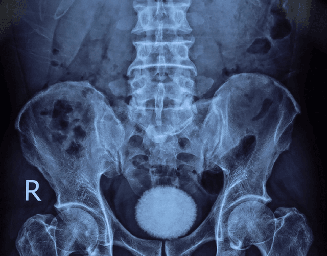 Người đàn ông 50 tuổi đau hạ vị kéo dài, bác sĩ sốc khi gắp ra thứ "đáng sợ" bằng quả trứng ngỗng- Ảnh 1.