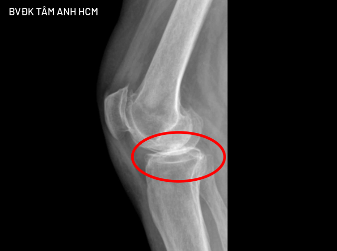 Hình X-quang cho thấy sụn khớp gối của bà Victoria gần như không còn, hai đầu xương ma sát vào nhau. Ảnh: Bệnh viện cung cấp