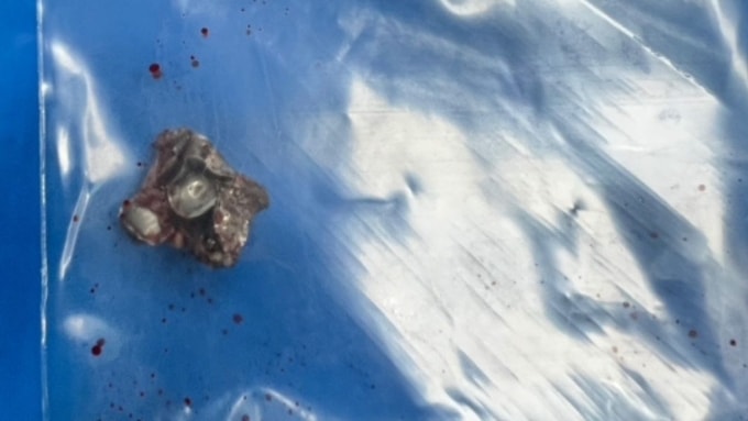 Mảnh đạn găm trong má nữ du khách. Ảnh: Amarin TV