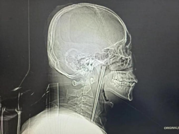 Hình ảnh X-quang cho thấy dị vật kim loại mắc kẹt trong cổ họng người đàn ông. Ảnh: Baidu