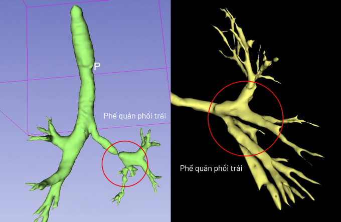 Ảnh chụp CT dựng hình 3D trước mổ (trái) và sau mổ (phải) cho thấy phần hẹp phế quản đã được khắc phục gần như hoàn toàn. Ảnh: Bệnh viện Đa khoa Tâm Anh