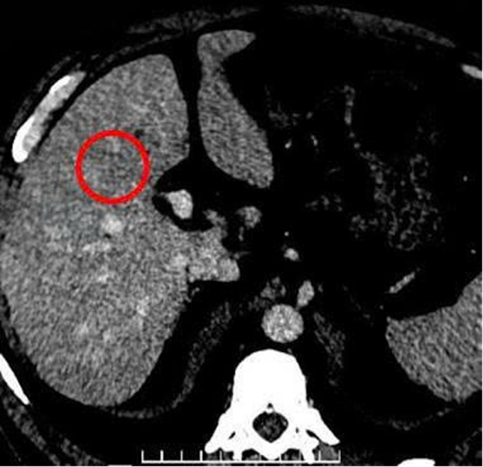 Kết quả CT cho thấy tổn thương gan (khoanh tròn màu đỏ). Ảnh: Bệnh viện Đa khoa Tâm Anh