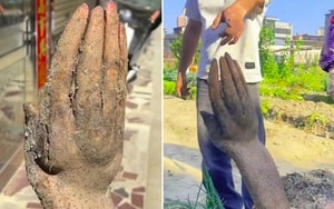 Người đàn ông đau bụng 36 tiếng, bác sĩ phát hiện "bí mật" bên trong - Ảnh 2.