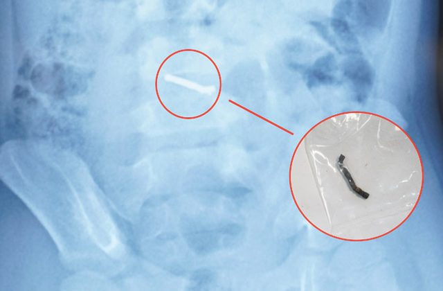 Bé trai 5 tuổi nuốt hàng chục viên nam châm gây thủng ruột - Ảnh 1.