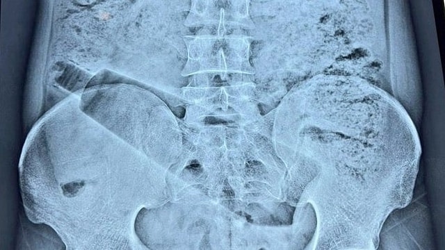 Người đàn ông đau bụng 36 tiếng, bác sĩ phát hiện "bí mật" bên trong - Ảnh 1.