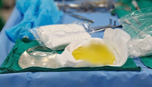 Vỡ túi ngực cả năm mà không hay biết, bác sĩ cảnh báo biến chứng âm thầm - Ảnh 1.