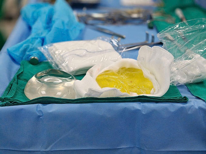 Bác sĩ tháo túi, rửa sạch khoang ngực và đặt dòng túi ngực khác cho bệnh nhân. Ảnh: Bác sĩ cung cấp