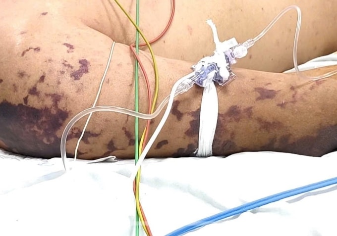 Tử ban xuất hiện trên cơ thể một bệnh nhân nhiễm não mô cầu hồi tháng 1. Ảnh: Bệnh viện Bệnh nhiệt đới Trung ương