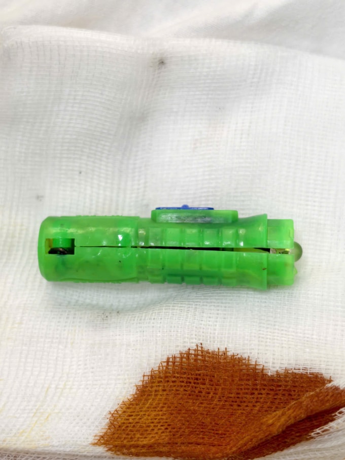 Chiếc pin đồ chơi mắc kẹt trong âm đạo bé gái. Ảnh: Bệnh viện cung cấp