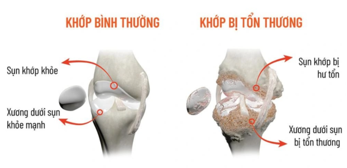 Sự thay đổi trong cấu trúc sụn và xương dưới sụn là nguyên nhân khiến khớp phát ra tiếng lạo xạo khi vận động. Ảnh: Công ty Cổ phần Dược phẩm Eco