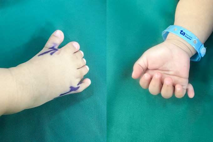 Mỗi bàn chân của bé có 7 ngón, mỗi bàn tay 6 ngón. Ảnh: Bệnh viện Đa khoa Tâm Anh