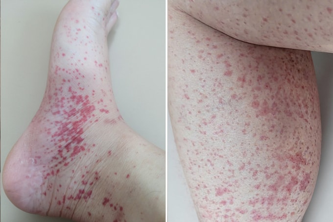 Các nốt ban đỏ dày đặc trên chân người bệnh. Ảnh: Bệnh viện Đa khoa Tâm Anh